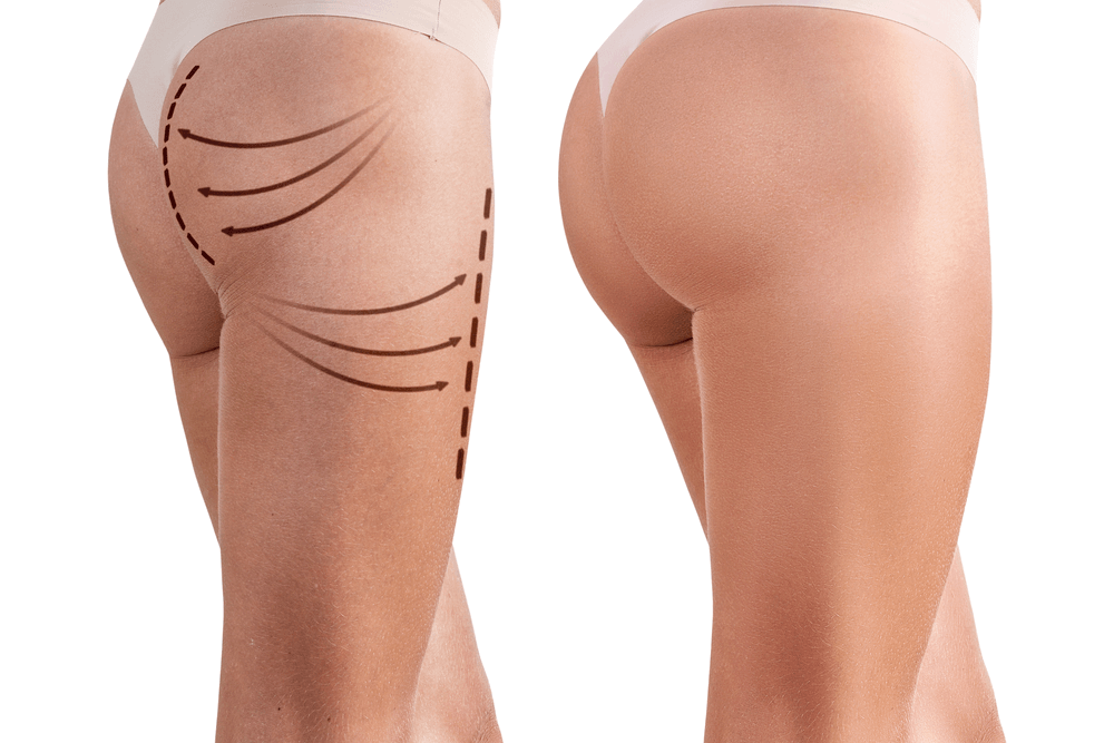 chi phi nang mong noi soi bao nhieu tien