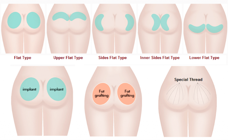 phau thuat nang mong 768x472 1