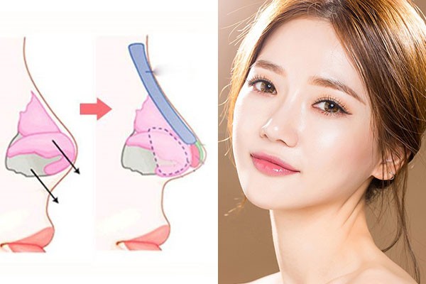 phuong phap nang mui boc sun 01